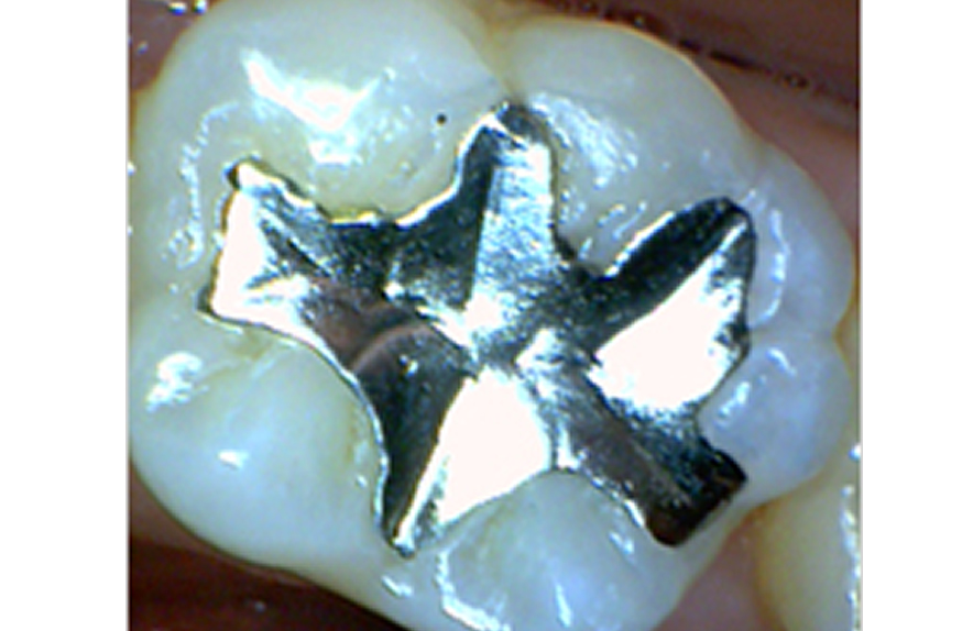 鴨宮　歯科　銀歯