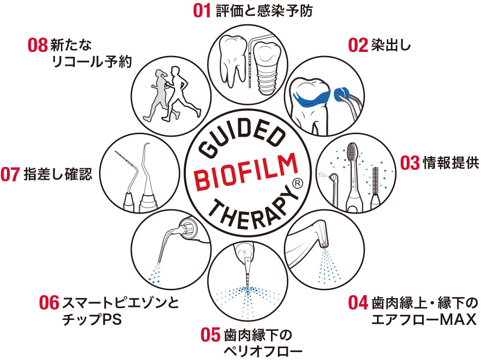 小田原市(鴨宮)の歯医者なら、鴨宮北口歯科のEMSエアフロー/GBT(Guided Biofilm Therapy)