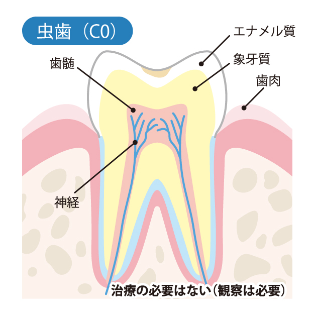 小田原市（鴨宮）の歯医者、鴨宮北口歯科で、むし歯治療