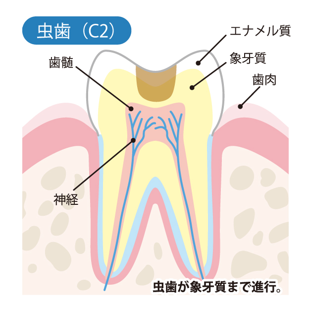 小田原市（鴨宮）の歯医者、鴨宮北口歯科で、むし歯治療