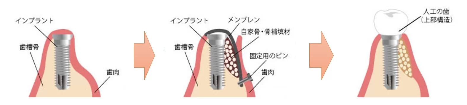 小田原市（鴨宮）の歯医者、鴨宮北口歯科のGBR法