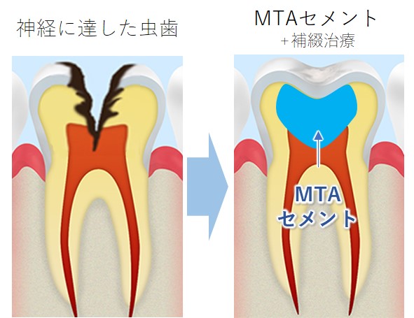 小田原市（鴨宮）の歯医者、鴨宮北口歯科のMTAセメント