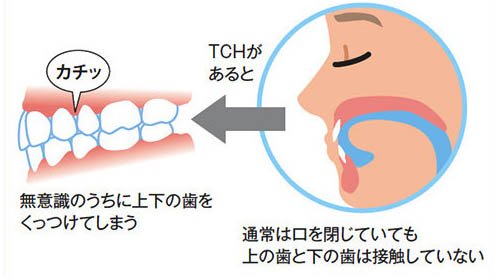 小田原市（鴨宮）の歯医者、鴨宮北口歯科の顎関節症治療